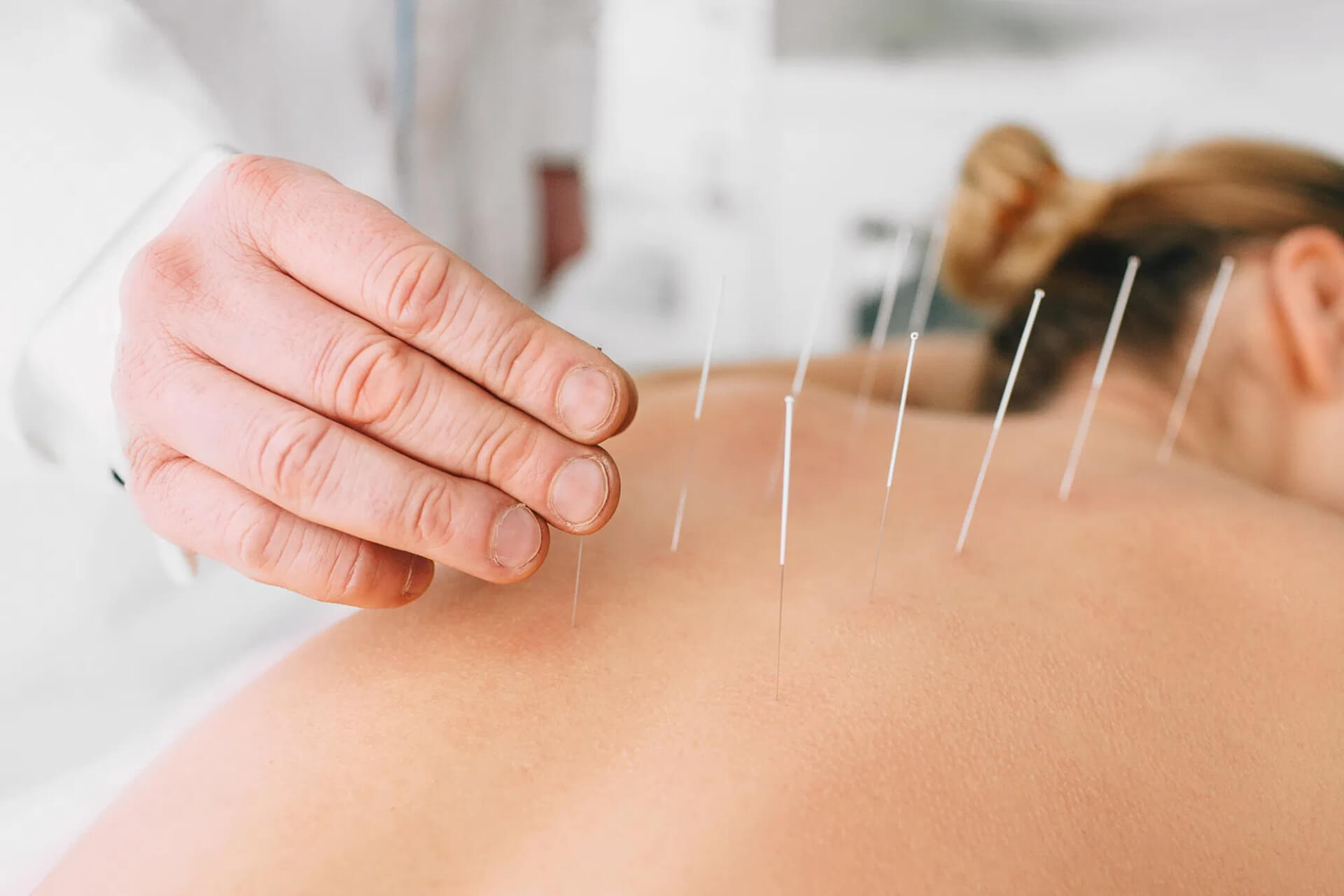 Acupuncture Treatment Charters Towers Dry Needling In Richmond Hill